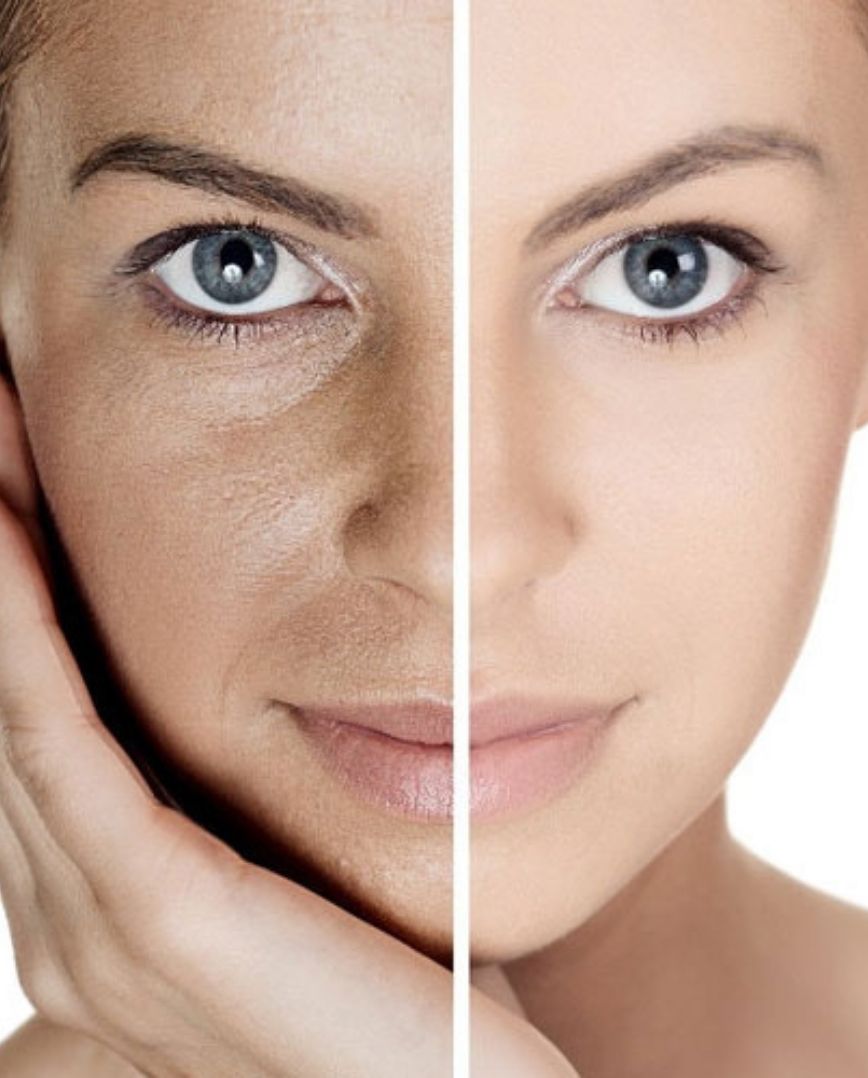 laser-treatments-for-pigmentation